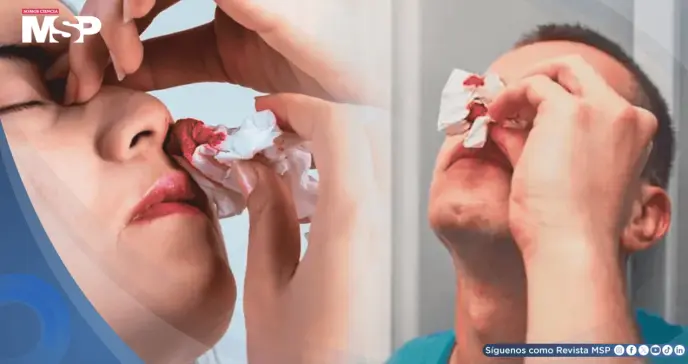 Por qué nunca debe inclinar la cabeza hacia atrás durante una hemorragia nasal Por qué nunca debe inclinar la cabeza hacia atrás durante una hemorragia nasal