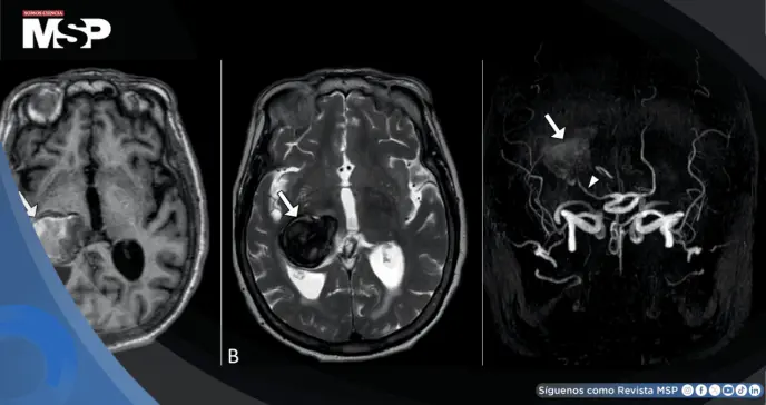 Dolor de cabeza y visión borrosa revelaron un aneurisma cerebral gigante en un hombre de 64 años Dolor de cabeza y visión borrosa revelaron un aneurisma cerebral gigante en un hombre de 64 años
