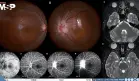 Disminución visual aguda y neurorretinitis asociada a Bartonella henselae transmitida por lamidas de gato