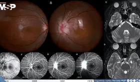 Disminución visual aguda y neurorretinitis asociada a Bartonella henselae transmitida por lamidas de gato