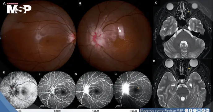 Disminución visual aguda y neurorretinitis asociada a Bartonella henselae transmitida por lamidas de gato Disminución visual aguda y neurorretinitis asociada a Bartonella henselae transmitida por lamidas de gato