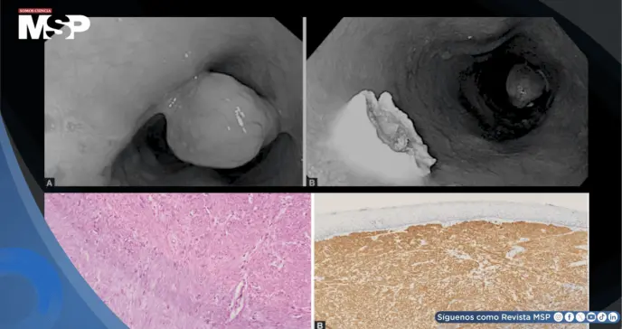 Mujer es diagnosticada con un pólipo tipo molusco en el esófago tras presentar disfagia y pérdida de peso Mujer es diagnosticada con un pólipo tipo molusco en el esófago tras presentar disfagia y pérdida de peso