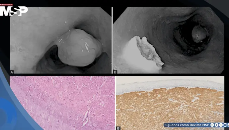 Mujer es diagnosticada con un pólipo tipo molusco en el esófago tras presentar disfagia y pérdida de peso