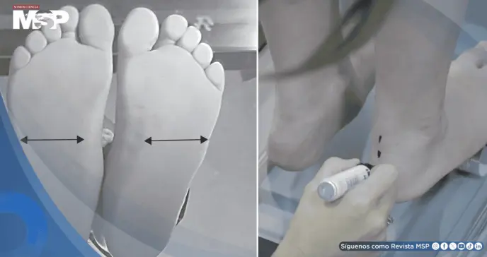 La obesidad infantil aumenta hasta un 40% la presión sobre el pie y podría alterar el desarrollo motor La obesidad infantil aumenta hasta un 40% la presión sobre el pie y podría alterar el desarrollo motor