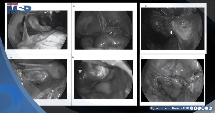 Detectan tuberculosis genital en mujer con útero desviado y los ovarios destruidos  Detectan tuberculosis genital en mujer con útero desviado y los ovarios destruidos
