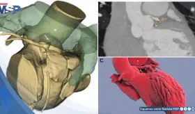 Isquemia por compresión de la arteria coronaria izquierda en paciente con hipertensión pulmonar
