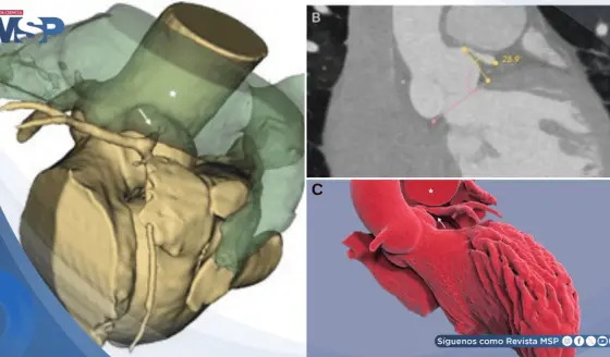 Isquemia por compresión de la arteria coronaria izquierda en paciente con hipertensión pulmonar