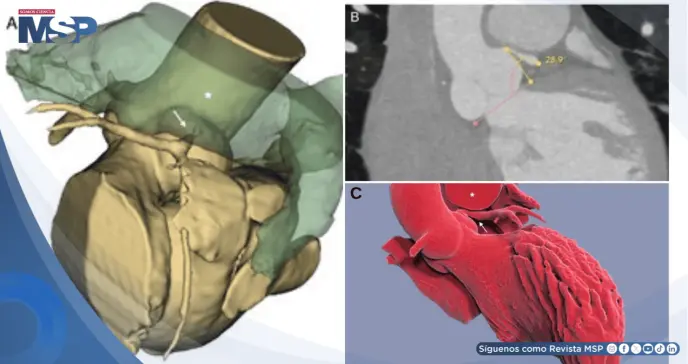 Isquemia por compresión de la arteria coronaria izquierda en paciente con hipertensión pulmonar Isquemia por compresión de la arteria coronaria izquierda en paciente con hipertensión pulmonar
