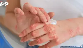 Nuevos tratamientos biol&oacute;gicos para la psoriasis logran 90% de efectividad y previenen da&ntilde;os articulares