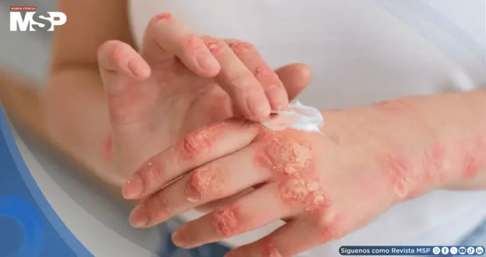 Nuevos tratamientos biológicos para la psoriasis logran 90% de efectividad y previenen daños articulares Nuevos tratamientos biológicos para la psoriasis logran 90% de efectividad y previenen daños articulares