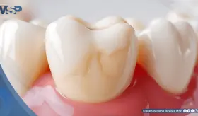 Cient&iacute;ficos crean gel que regenera el esmalte dental y podr&iacute;a cambiar el tratamiento de caries