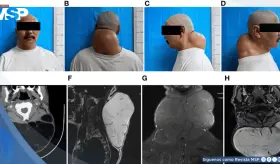 Detectan lipoma gigante posterior del cuello de 20 cm con caracter&iacute;sticas adiposas encapsuladas