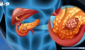 Agrandamiento del conducto pancre&aacute;tico podr&iacute;a ser una se&ntilde;al temprana de c&aacute;ncer de p&aacute;ncreas