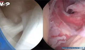 &iquest;Inmovilidad y dolor sordo en el hombro? Podr&iacute;a ser capsulitis adhesiva u hombro congelado