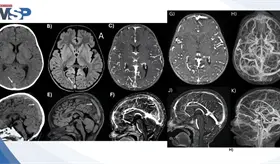Trombosis venosa cerebral y convulsi&oacute;n focal en ni&ntilde;o de 2 a&ntilde;os por consumo excesivo de leche de vaca