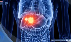 5 se&ntilde;ales del c&aacute;ncer de h&iacute;gado y enfermedades que aumentan su riesgo: hepatitis, cirrosis e h&iacute;gado graso