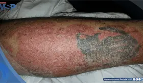 Tatuaje activa la psoriasis en un paciente en remisi&oacute;n