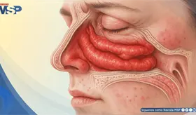 &iquest;Nariz tapada sin gripe? 7 causas detr&aacute;s de la congesti&oacute;n nasal persistente y cu&aacute;ndo consultar