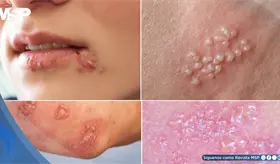 As&iacute; puede verse el herpes en mujeres: S&iacute;ntomas, tratamiento y cu&aacute;ndo consultar al m&eacute;dico