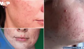 Ros&aacute;cea papulopustular: brotes inflamatorios se confundir&iacute;an con acn&eacute; grave &iquest;Qu&eacute; lo desencadena? 