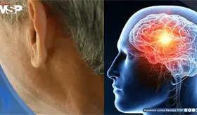 P&eacute;rdida auditiva en la mediana edad aumentar&iacute;a el 71% el riesgo de demencia, seg&uacute;n estudio