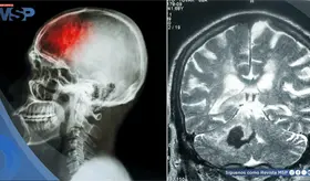 &acute;Falsos ictus&acute; en ni&ntilde;os: Crisis epil&eacute;pticas o migra&ntilde;as podr&iacute;an imitar un accidente cerebrovascular