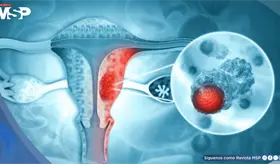 F&aacute;rmaco para el asma complementar&iacute;a el tratamiento de c&aacute;ncer de ovario al superar barreras inmunitarias