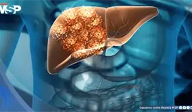 An&aacute;lisis de sangre predice riesgo de cirrosis o c&aacute;ncer de h&iacute;gado hasta 10 a&ntilde;os antes con 88% de precisi&oacute;n