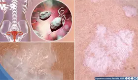 Ardor y prurito en la zona genital: As&iacute; se reconoce y trata el liquen escleroso