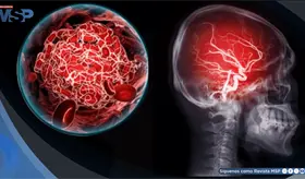 El cerebro escucha, pero no procesa de la misma forma: as&iacute; afecta un ictus la comprensi&oacute;n del habla