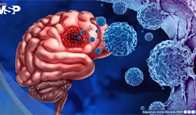 Parche postquir&uacute;rgico reducir&iacute;a la recurrencia del glioblastoma: ataca el 90% de c&eacute;lulas tumorales 