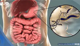 La erradicaci&oacute;n de H. pylori reduce riesgo de c&aacute;ncer g&aacute;strico en todas las edades, incluso en mayores