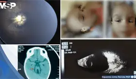 Vasculatura fetal y s&iacute;ndrome de Morning Glory bilateral en lactante de un a&ntilde;o con s&iacute;ndrome de Joubert