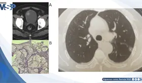 Hematuria revel&oacute; adenocarcinoma mucinoso de c&eacute;lulas en anillo de vejiga con met&aacute;stasis pulmonar y &oacute;sea 