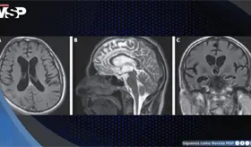 Neuros&iacute;filis con psicosis, demencia e incontinencia tras a&ntilde;os de tratamiento psiqui&aacute;trico sin respuesta