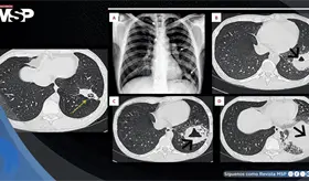Absceso pulmonar por Rhodococcus revela VIH avanzado no detectado en paciente con fiebre y dolor tor&aacute;cico