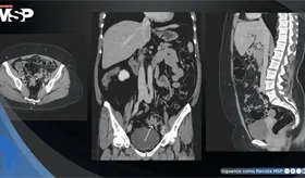 Endometriosis intestinal infiltrativa simul&oacute; c&aacute;ncer colorrectal al producir sangrado rectal y estenosis 