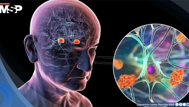 Un an&aacute;lisis de sangre podr&iacute;a predecir el alzh&eacute;imer hasta 20 a&ntilde;os antes de que aparezcan los s&iacute;ntomas
