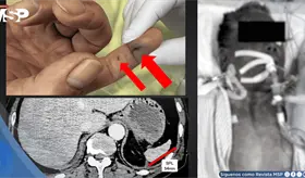 Sepsis tras mordedura de perro en hombre hipertenso con infecci&oacute;n por Capnocytophaga y atrofia espl&eacute;nica