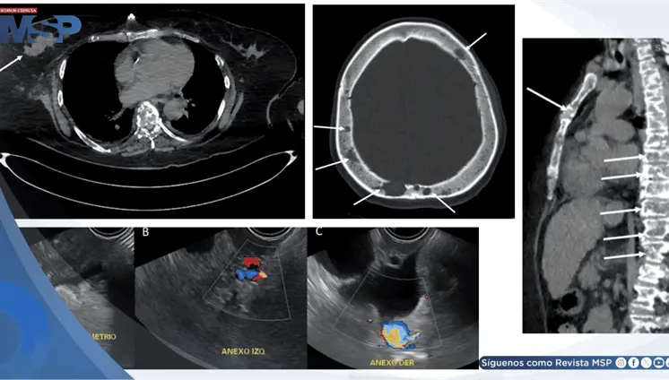 Pancreatitis aguda como presentación inicial de cáncer de mama metastásico debido a hipercalcemia maligna Pancreatitis aguda como presentación inicial de cáncer de mama metastásico debido a hipercalcemia maligna