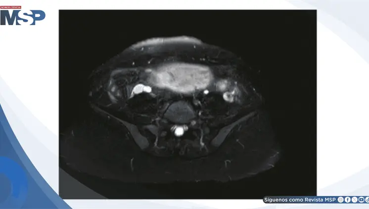 Apendicitis aguda enmascarada por hiperemesis gravídica:Dolor lumbar intratable en gestante de 14 semanas Apendicitis aguda enmascarada por hiperemesis gravídica:Dolor lumbar intratable en gestante de 14 semanas