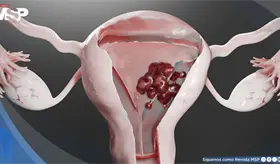 Co&aacute;gulos del tama&ntilde;o de una mano: Se&ntilde;al de alarma que confundieron con menstruaci&oacute;n y ocultaba c&aacute;ncer 