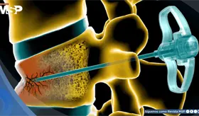 &iquest;Qu&eacute; es la vertebroplastia y c&oacute;mo el cemento &oacute;seo puede aliviar las fracturas causadas por osteoporosis?