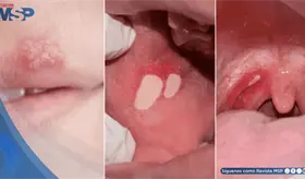 7 enfermedades que puedes contraer por practicar sexo oral y c&oacute;mo prevenirlas