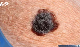 Asimetr&iacute;a, color irregular y bordes difusos: C&oacute;mo reconocer un lunar peligroso y el c&aacute;ncer de piel 