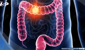 Sangre en las heces, dolor abdominal y fatiga: Se&ntilde;ales del c&aacute;ncer colorrectal que ha aumentado en j&oacute;venes