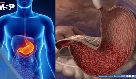 "Gastritis nerviosa": C&oacute;mo el estr&eacute;s y la ansiedad intensifican la acidez y el ardor estomacal