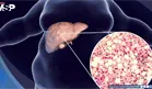 H&iacute;gado graso: Estas son algunas recomendaciones para prevenirlo y c&oacute;mo tratarlo