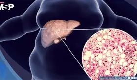 H&iacute;gado graso: Estas son algunas recomendaciones para prevenirlo y c&oacute;mo tratarlo