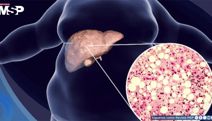 Hígado graso: Estas son algunas recomendaciones para prevenirlo y cómo tratarlo Hígado graso: Estas son algunas recomendaciones para prevenirlo y cómo tratarlo